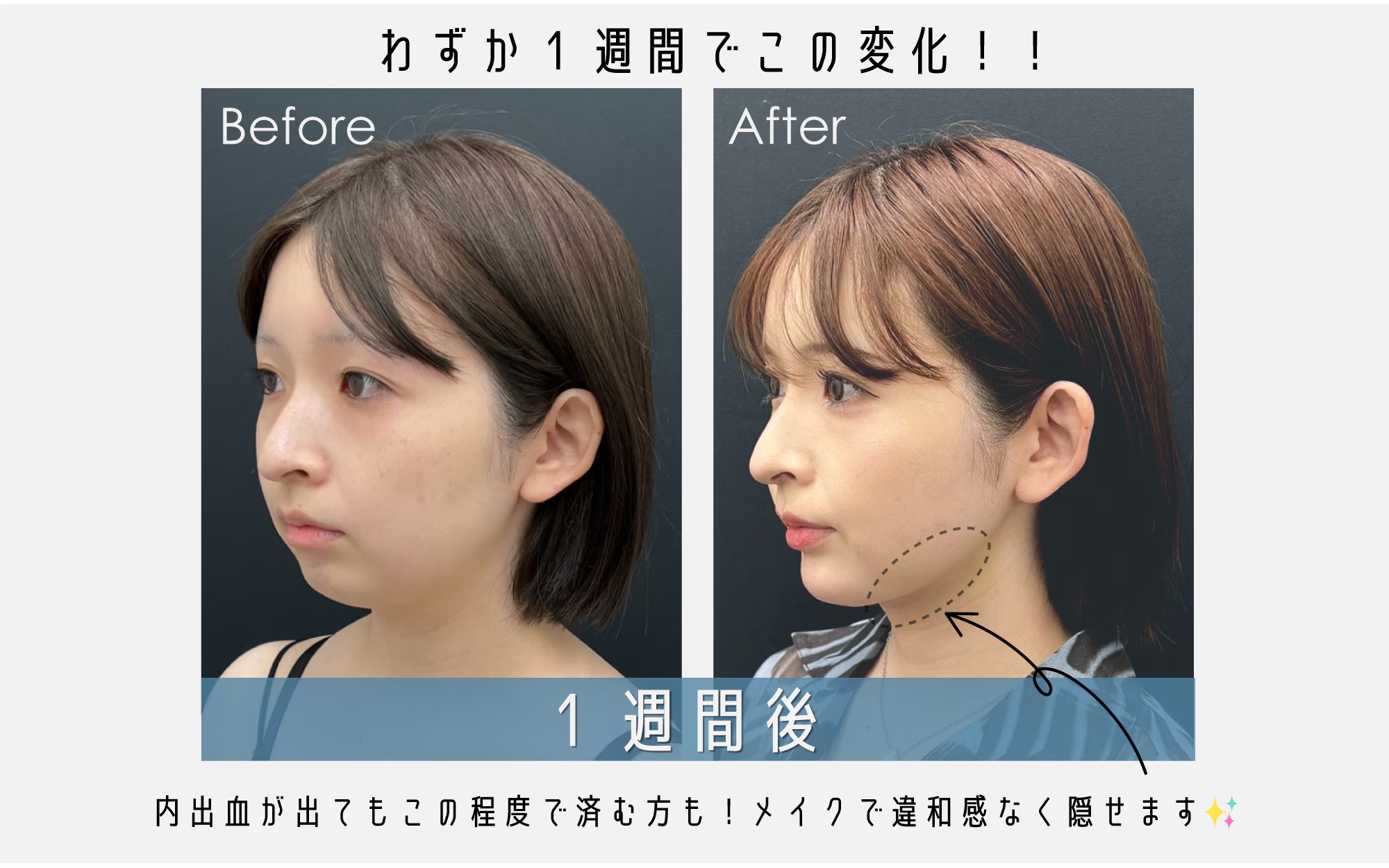 驚きの仕上がり！わずか1週間でこの変化✨